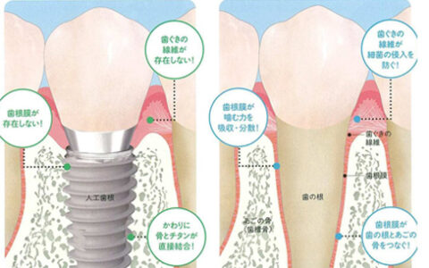 インプラントと天然歯はなにが違うの？