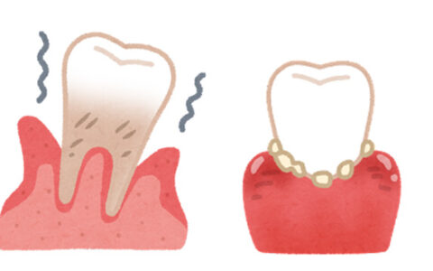 歯周病と体のひずみ