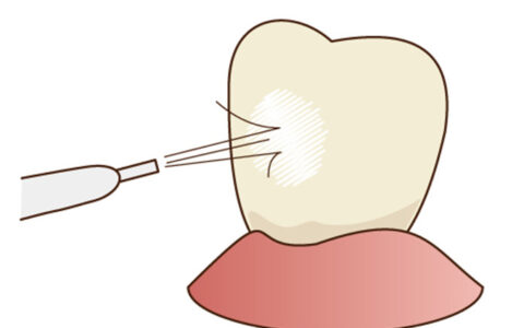 歯周病をふせぐ歯磨きの方法
