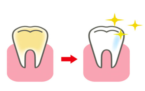 歯のホワイトニング