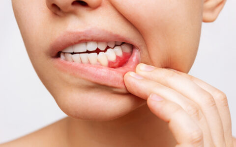 歯周病で重要なのは予防です！