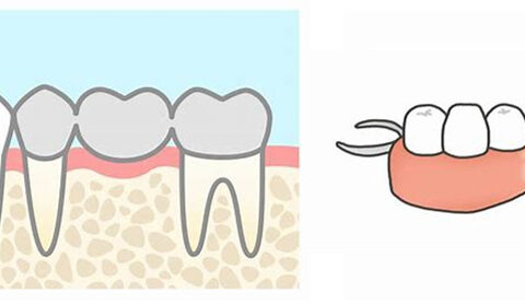 ブリッジと入れ歯について