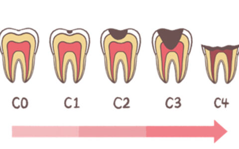 虫歯ってどのくらいで進行する？