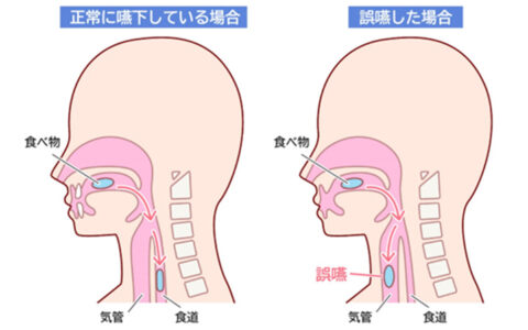 誤嚥性肺炎にならないために