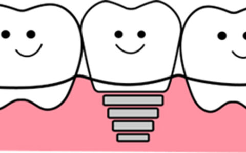 はじめてのインプラント、これだけは知っておこう
