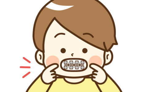 小児矯正が必要な歯並びのタイプ