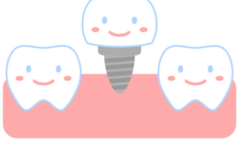 🦷インプラント治療とは？〜失った歯を取り戻す選択肢〜
