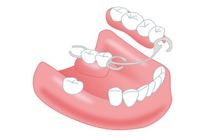 入れ歯とブリッジ、どう違うの？