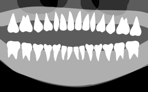 歯のレントゲンで全身の健康をチェック！