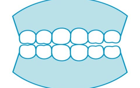 ブリッジと入れ歯の違いは？