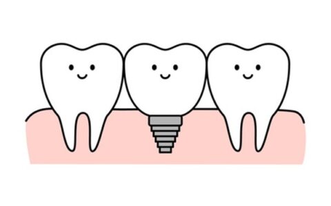 インプラントを長持ちさせる秘訣