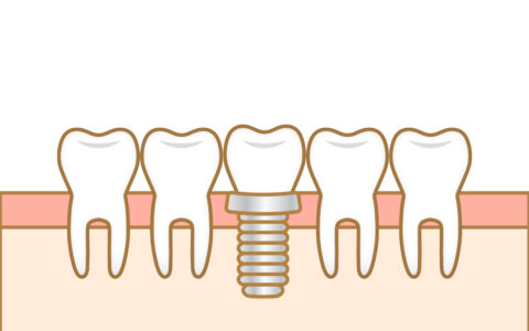 これからの毎日を安心して過ごすために　〜インプラントという選択肢〜