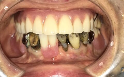 歯や舌の黒ずみは「衰え」のサイン？　鉄剤と口腔機能の意外な関係