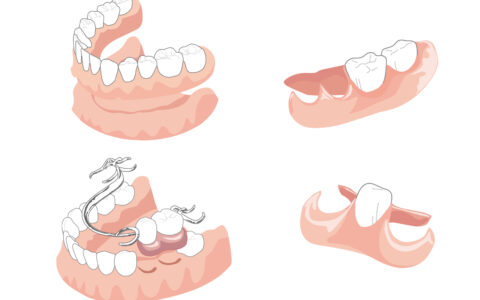入れ歯とブリッジの違いについて