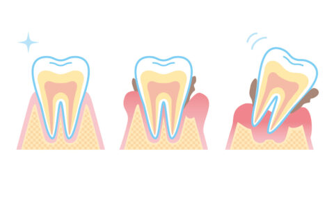 将来のための歯ぐきケア