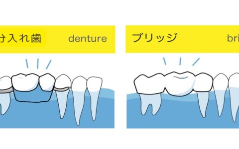 歯を失ったらどうする？入れ歯とブリッジの違い