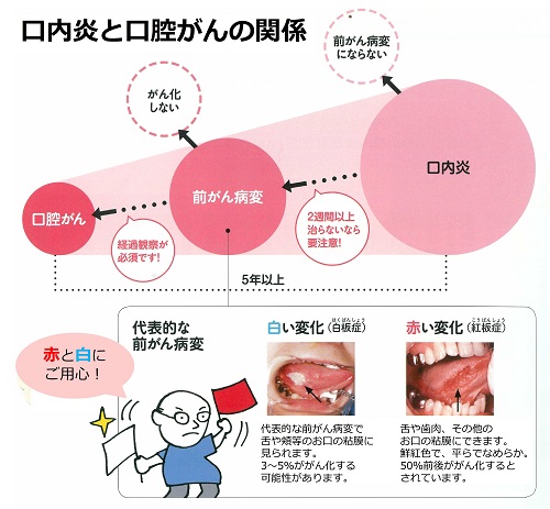 口内炎との違いは？（口腔がんシリーズ3） | 医療法人社団徳治会 徳治会歯科医院宇城 [旧 吉永歯科医院]｜熊本県宇城市